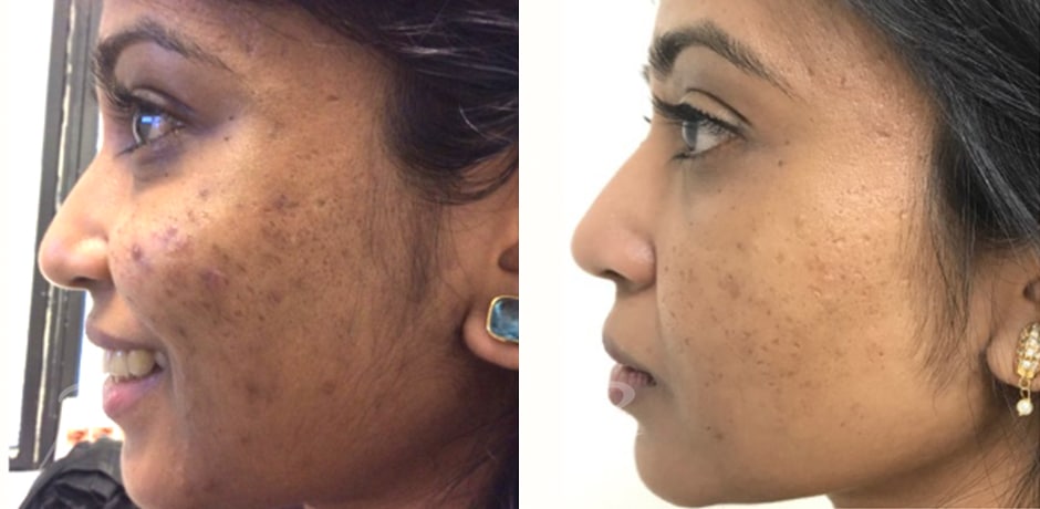 microneedling before and after new york 5